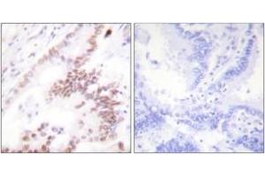 Immunohistochemistry analysis of paraffin-embedded human lung carcinoma tissue, using p300 Antibody. (p300 anticorps  (AA 1-50))