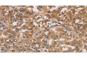 Immunohistochemistry of paraffin-embedded Human thyroid cancer tissue using DSTN Polyclonal Antibody at dilution 1:30