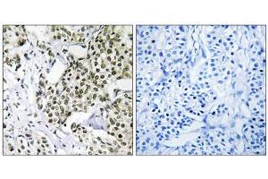 Immunohistochemistry analysis of paraffin-embedded human breast carcinoma tissue using CAGE1 antibody. (CAGE1 anticorps  (C-Term))