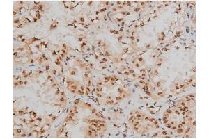 ABIN6267400 at 1/200 staining Human lung cancer tissue sections by IHC-P. (CREB1 anticorps  (pSer133))