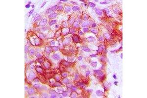 Immunohistochemical analysis of GIP Receptor staining in human breast cancer formalin fixed paraffin embedded tissue section.
