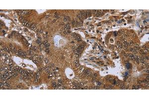 Immunohistochemistry of paraffin-embedded Human colon cancer using FHIT Polyclonal Antibody at dilution of 1:30