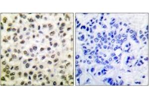 Immunohistochemistry analysis of paraffin-embedded human breast carcinoma tissue, using STAT5B (Ab-731) Antibody. (STAT5B anticorps  (AA 697-746))