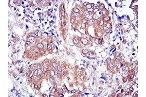 Immunohistochemical analysis of paraffin-embedded breast cancer tissues using MAPK3 mouse mAb with DAB staining. (ERK1 anticorps)
