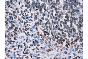 Immunohistochemical staining of paraffin-embedded colon tissue using anti-TTLL12mouse monoclonal antibody. (TTLL12 anticorps)