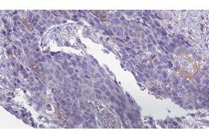 ABIN6279509 at 1/100 staining Human Head and neck cancer tissue by IHC-P. (KCNJ13 anticorps  (Internal Region))