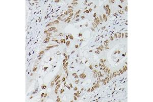 Immunohistochemistry of paraffin-embedded human colon carcinoma using G antibody (ABIN6133721, ABIN6140975, ABIN6140976 and ABIN6217864) at dilution of 1:150 (40x lens).