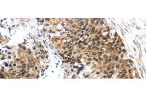 Immunohistochemistry of paraffin-embedded Human esophagus cancer tissue using TRIM74 Polyclonal Antibody at dilution 1:45 (TRIM74 anticorps)