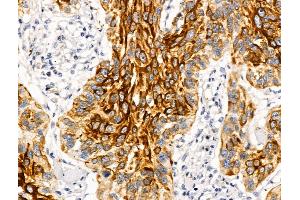 ABIN6262775 and ABIN6269025 at 1/100 staining Human esophageal cancer by IHC-P. (KRT16 anticorps  (C-Term))