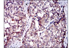 Immunohistochemical analysis of paraffin-embedded bladder cancer tissues using SERPINA7 mouse mAb with DAB staining.