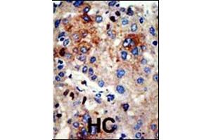 Formalin-fixed and paraffin-embedded human cancer tissue reacted with the primary antibody, which was peroxidase-conjugated to the secondary antibody, followed by AEC staining.