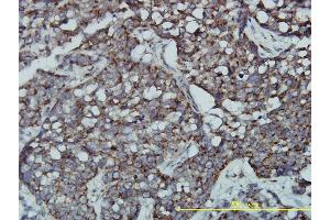 Immunoperoxidase of monoclonal antibody to GPR3 on formalin-fixed paraffin-embedded human transitional cell carcinoma tissue.