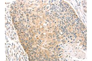 The image on the left is immunohistochemistry of paraffin-embedded Human esophagus cancer tissue using ABIN7130971(SCAP Antibody) at dilution 1/20, on the right is treated with fusion protein.