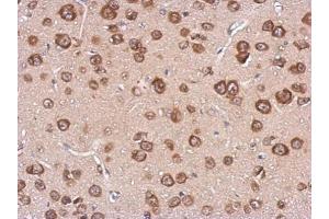 IHC-P Image Immunohistochemical analysis of paraffin-embedded CL1-5 xenograft, using cystatin F, antibody at 1:500 dilution. (CST7 anticorps)