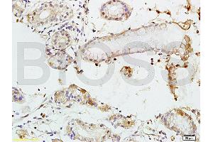 Formalin-fixed and paraffin embedded human colon carcinoma tissue labeled with Rabbit Anti-TEM1/CD248 Polyclonal Antibody (ABIN677573) at 1:200 followed by conjugation to the secondary antibody and DAB staining.