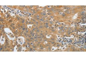 Immunohistochemistry of paraffin-embedded Human ovarian cancer using Amphiphysin I Polyclonal Antibody at dilution of 1:30 (Amphiphysin anticorps)