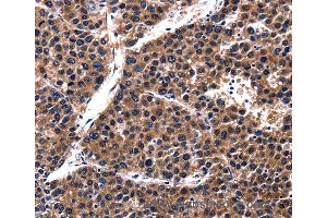 Immunohistochemistry of Human liver cancer using CUL4A Polyclonal Antibody at dilution of 1:62 (Cullin 4A anticorps)