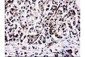 Immunohistochemical staining of paraffin-embedded Adenocarcinoma of Human colon tissue using anti-FAM40A mouse monoclonal antibody. (STRIP1 anticorps)