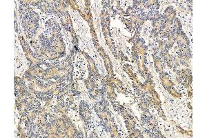 ABIN7095892 and ABIN7099954 at 1/100 staining human colorectal cancer by IHC-P. (TFPI2 anticorps)