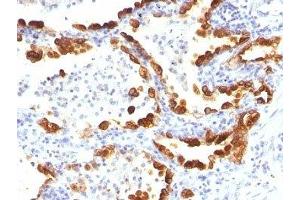 Formalin-fixed, paraffin-embedded human lung carcinoma stained with Cytokeratin 18 antibody (KRT18/835). (Cytokeratin 18 anticorps)