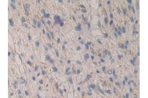 Detection of MAPKAPK2 in Human Glioma Tissue using Polyclonal Antibody to MAP Kinase Activated Protein Kinase 2 (MAPKAPK2) (MAPKAP Kinase 2 anticorps  (AA 139-367))