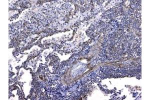 IHC testing of FFPE human lung cancer tissue with GSTM3 antibody at 1ug/ml. (GSTM3 anticorps)