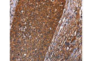 Immunohistochemistry of Human colon cancer using GUK1 Polyclonal Antibody at dilution of 1:40 (GUK1 anticorps)