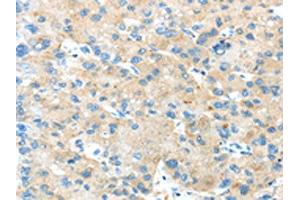 The image on the left is immunohistochemistry of paraffin-embedded Human liver cancer tissue using ABIN7189804(ANGPTL5 Antibody) at dilution 1/25, on the right is treated with synthetic peptide. (ANGPTL5 anticorps)