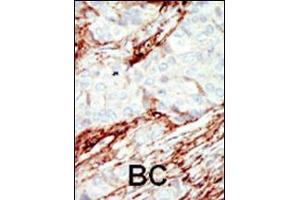 Formalin-fixed and paraffin-embedded human cancer tissue reacted with the primary antibody, which was peroxidase-conjugated to the secondary antibody, followed by DAB staining.