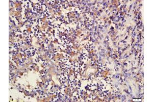 Formalin-fixed and paraffin embedded human laryngeal tissue  labeled with Rabbit Anti-DcR2/TNFRSF10D Polyclonal Antibody, Unconjugated (ABIN733088) at 1:200 followed by conjugation to the secondary antibody and DAB staining