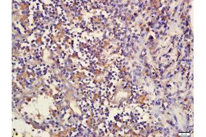 Formalin-fixed and paraffin embedded human laryngeal tissue  labeled with Rabbit Anti-DcR2/TNFRSF10D Polyclonal Antibody, Unconjugated (ABIN733088) at 1:200 followed by conjugation to the secondary antibody and DAB staining (DcR2 anticorps)
