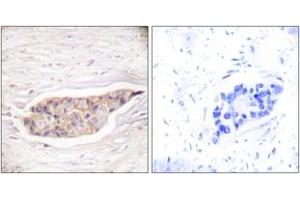 Immunohistochemistry analysis of paraffin-embedded human breast carcinoma tissue, using Annexin A6 Antibody. (ANXA6 anticorps  (AA 1-50))