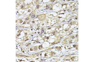 Immunohistochemistry of paraffin-embedded human liver cancer using PSMB3 antibody (ABIN6131929, ABIN6146317, ABIN6146318 and ABIN6225280) at dilution of 1:100 (40x lens).