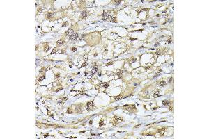 Immunohistochemistry of paraffin-embedded human liver cancer using PSMB3 antibody (ABIN6131929, ABIN6146317, ABIN6146318 and ABIN6225280) at dilution of 1:100 (40x lens). (PSMB3 anticorps  (AA 1-205))