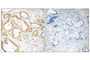 Immunohistochemistry analysis of paraffin-embedded human colon carcinoma tissue using SEPT6 antibody. (Septin 6 anticorps  (Internal Region))