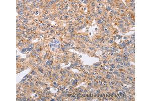 Immunohistochemistry of Human lung cancer using PPP1CB Polyclonal Antibody at dilution of 1:40