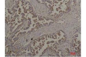 Immunohistochemistry (IHC) analysis of paraffin-embedded Human Lung Carcinoma using Flotillin-2 Rabbit Polyclonal Antibody diluted at 1:200. (Flotillin 2 anticorps)