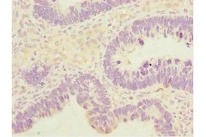 Immunohistochemistry of paraffin-embedded human ovarian cancer using ABIN7171132 at dilution of 1:100 (SYCE1 anticorps  (AA 132-351))