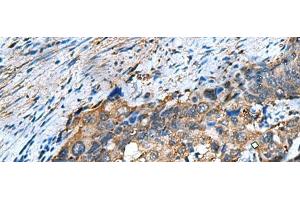 Immunohistochemistry of paraffin-embedded Human cervical cancer tissue using COMMD9 Polyclonal Antibody at dilution of 1:60(x200)