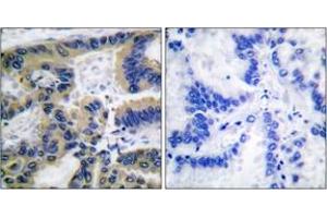 Immunohistochemistry analysis of paraffin-embedded human lung carcinoma tissue, using Caspase 7 (Cleaved-Asp198) Antibody.