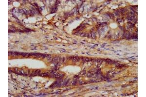 IHC image of ABIN7147493 diluted at 1:300 and staining in paraffin-embedded human colon cancer performed on a Leica BondTM system.