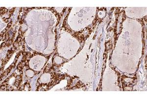 ABIN6266446 at 1/100 staining Human thyroid cancer tissue by IHC-P. (CD28 anticorps  (C-Term))