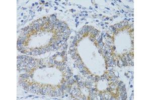 Immunohistochemistry of paraffin-embedded Human colon carcinoma using DNAJC19 Polyclonal Antibody at dilution of 1:100 (40x lens). (DNAJC19 anticorps)
