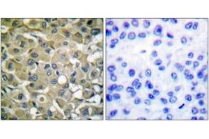 Immunohistochemistry analysis of paraffin-embedded human breast carcinoma tissue, using Keratin 18 (Ab-33) Antibody. (Cytokeratin 18 anticorps  (AA 1-50))