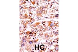 Formalin-fixed and paraffin-embedded human cancer tissue reacted with the primary antibody, which was peroxidase-conjugated to the secondary antibody, followed by AEC staining. (p21 anticorps  (pThr57))