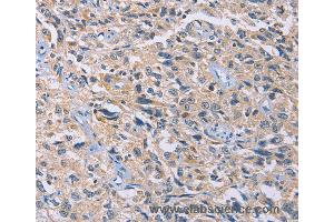 Immunohistochemistry of Human esophagus cancer using GNB5 Polyclonal Antibody at dilution of 1:20 (GNB5 anticorps)