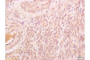 Formalin-fixed and paraffin embedded human endometrium carcinoma labeled with Rabbit Anti Phospho-Talin (Ser425) Polyclonal Antibody, Unconjugated  at 1:200 followed by conjugation to the secondary antibody and DAB staining (Talin anticorps  (pSer425))