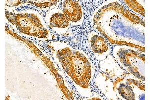ABIN6257299 and ABIN6275373 at 1/100 staining Human ovarian cancer by IHC-P. (KCNK17 anticorps)