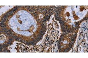 Immunohistochemistry of paraffin-embedded Human colon cancer tissue using FGF18 Polyclonal Antibody at dilution 1:40