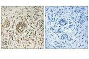 Immunohistochemistry analysis of paraffin-embedded human breast carcinoma tissue, using CIB2 antibody. (CIB2 anticorps)